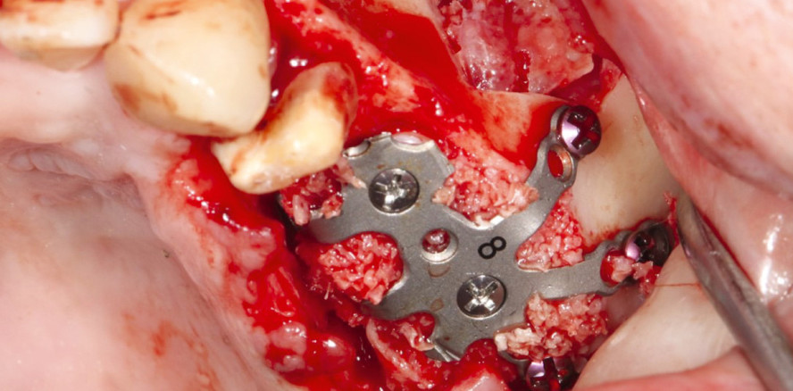 „Floating Implants“  mit Keramikimplantaten