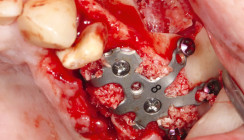 „Floating Implants“  mit Keramikimplantaten