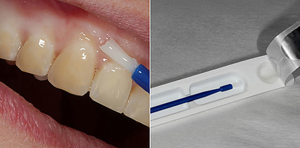 Fluoridlack: Punktet in Applikation, Geschmack und Farbe