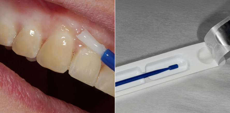 Fluoridlack: Punktet in Applikation, Geschmack und Farbe