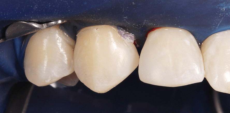 Formveränderung mit direkten Kompo­sitrestaurationen