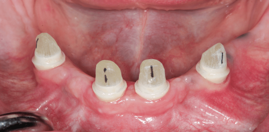 Full-Arch-Versorgung im Unterkiefer trotz Parodontitis