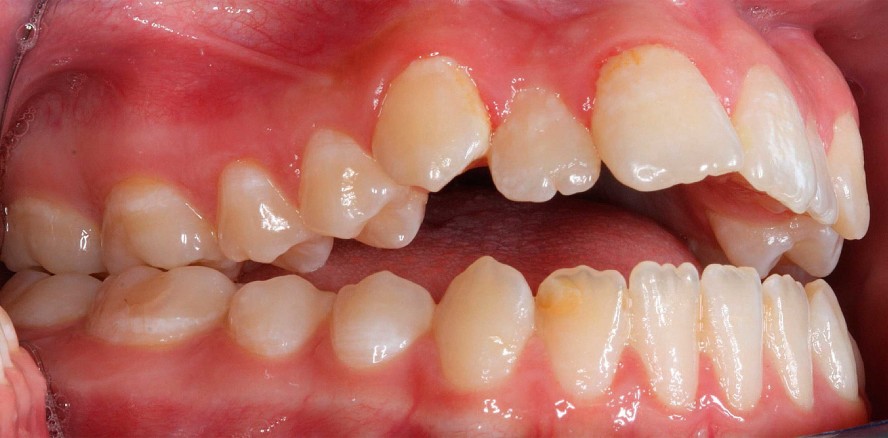 Ganzheitlicher Ansatz zur Behandlung des offenen Bisses