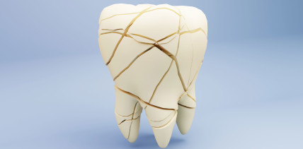 Kann man Zahnschmelz wirklich wieder aufbauen? Neues Protein-Gel verspricht Regeneration