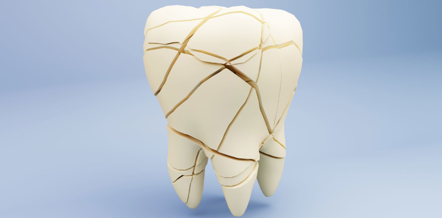 Kann man Zahnschmelz wirklich wieder aufbauen? Neues Protein-Gel verspricht Regeneration