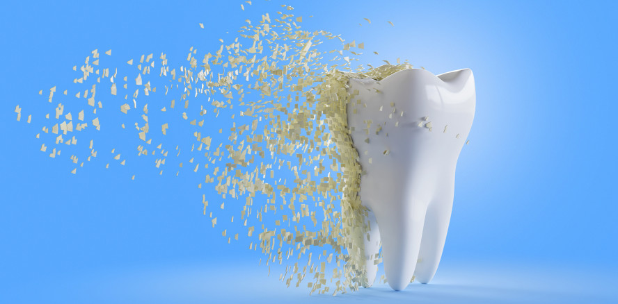 Gendefekte führen zu Zahnschmelzfehlbildungen