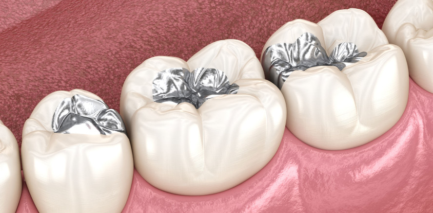 Gesetzgebungsentwurf zum Amalgam-Ausstieg 2025 veröffentlicht