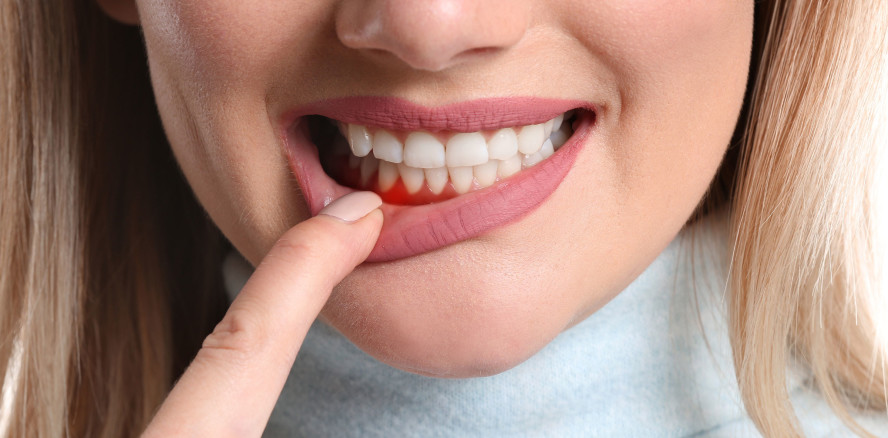 Gingivitis: Wie Mundgesundheit den Körper beeinflusst