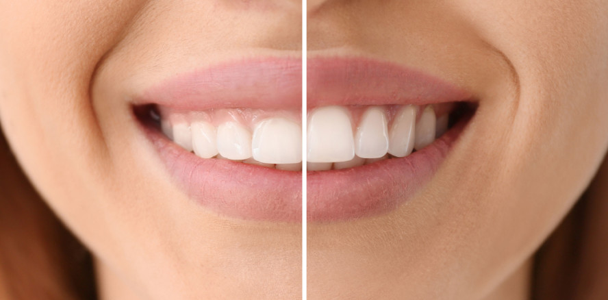 Gummy Smile: Was gilt als attraktiv, was nicht?