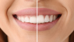 Gummy Smile: Was gilt als attraktiv, was nicht?