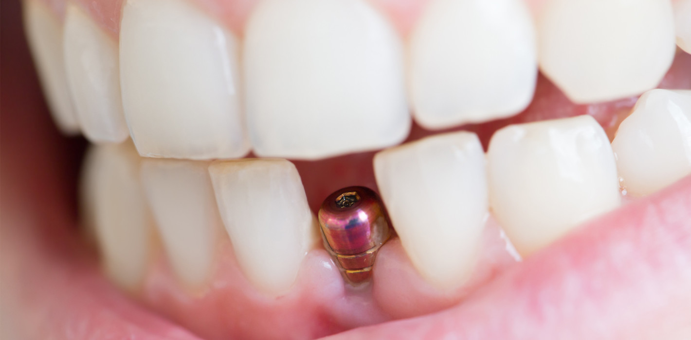 Wie stehen die Erfolgschancen von Implantaten bei HIV-Patienten?