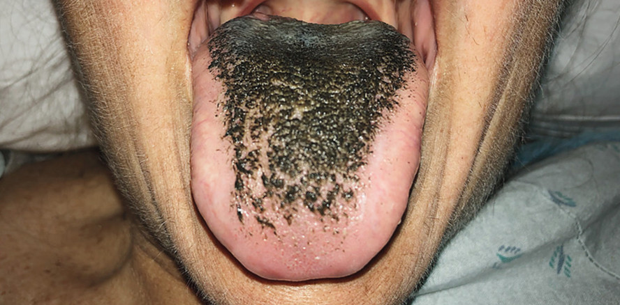 Nach Antibiotikagabe: Frau wachsen Haare auf der Zunge