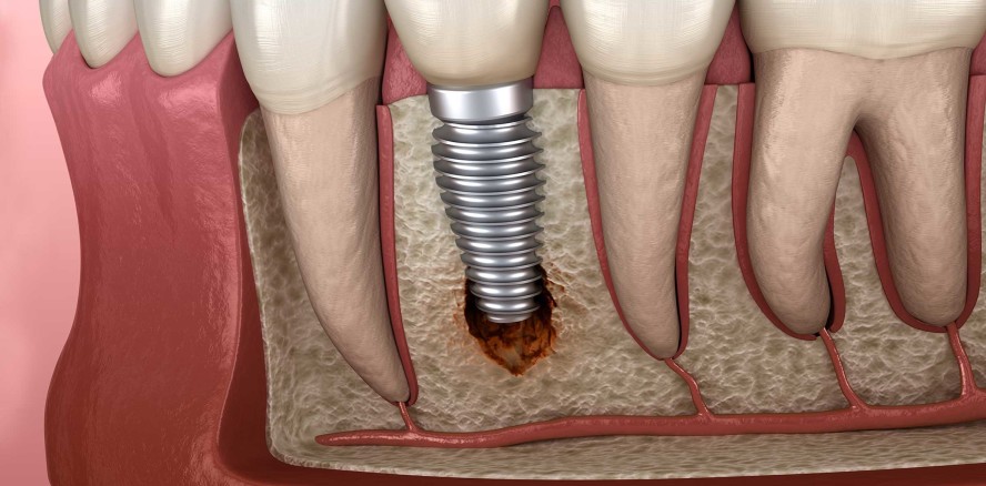 Herausforderungen bei biologischen Komplikationen