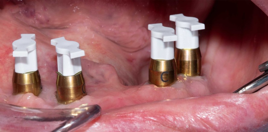 How to Implantat- und Stegversorgung – (Teil 1)