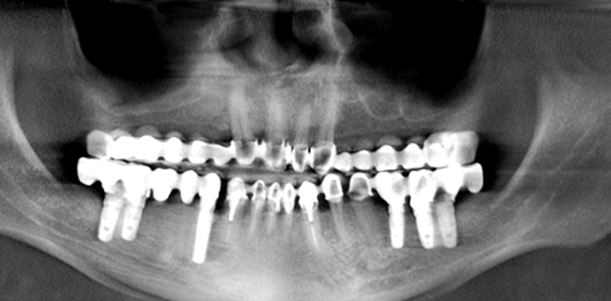 Hybridbrücke mit Implantaten 38/48 und Anhänger 39/49