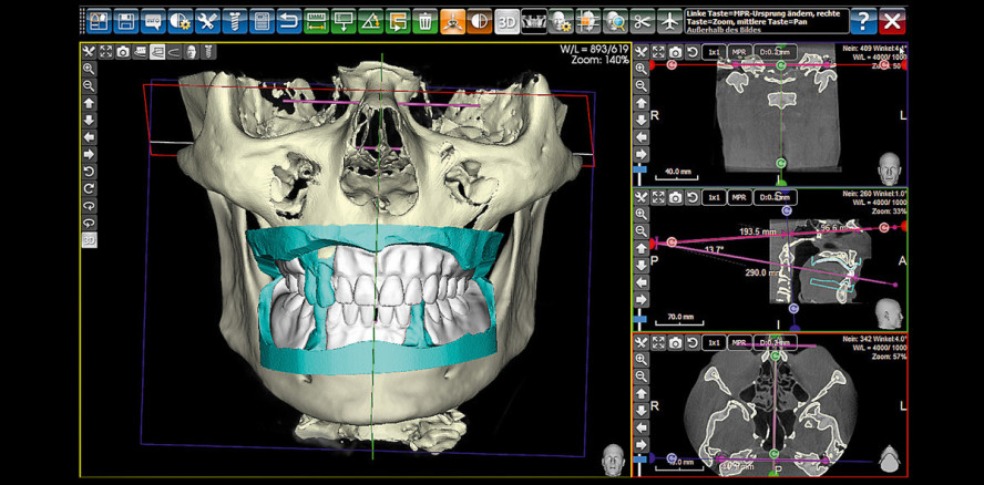Vollständiger digitaler Workflow für die Totalprothetik