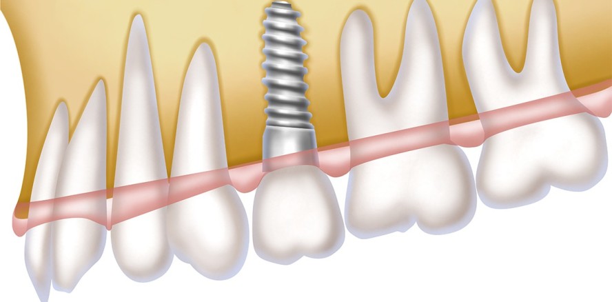 Implantate, Teilprothese oder beides?