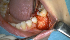 Implantation und Augmentation eines bukkalen Knochendefekts