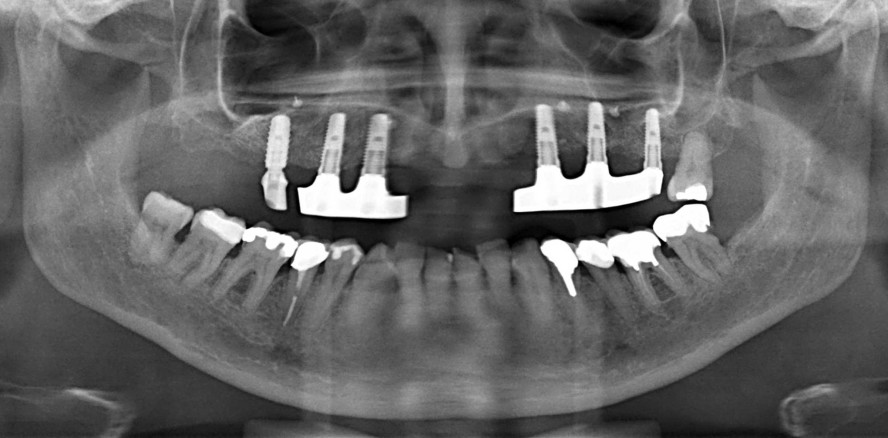 Implantatprothetische Versorgung des subtotalen Oberkiefers