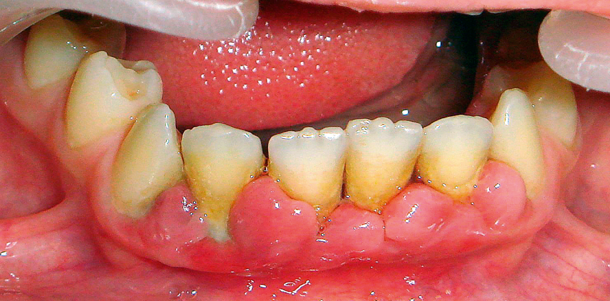 KFO-Behandlung von parodontal erkrankten Patienten (Teil 1)