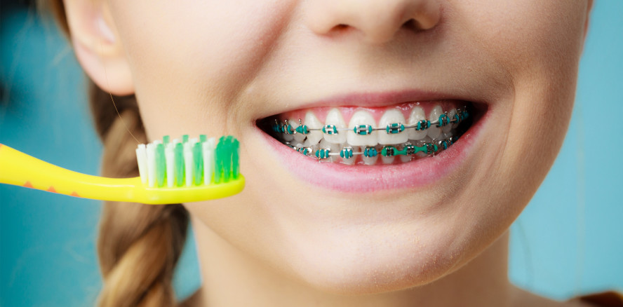 KFO-Behandlung: Ein Plus an Fluorid kann Kariesrisiko senken