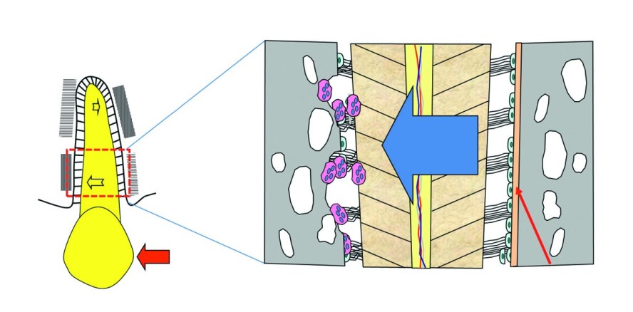 Beschleunigte Zahnbewegung durch LIPUS