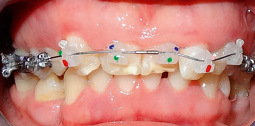 KFO-Behandlung von parodontal erkrankten Patienten (Teil 2)