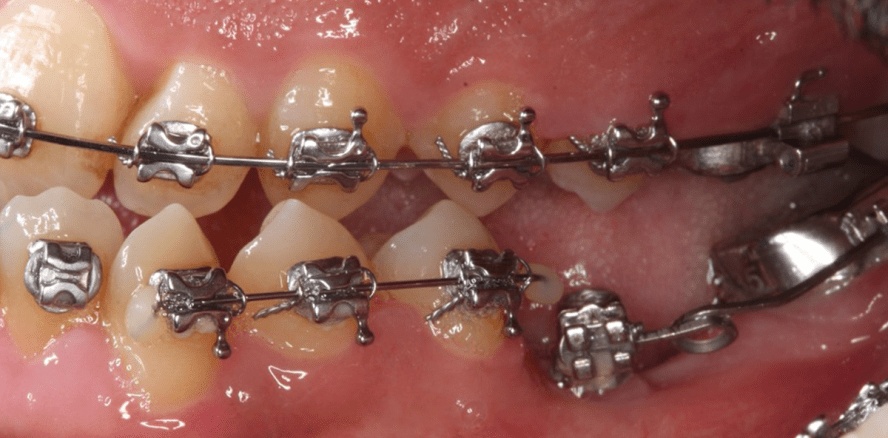 Kieferorthopädische Implantate für orthodontische und orthopädische Maßnahmen