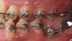 Kieferorthopädische Implantate für orthodontische und orthopädische Maßnahmen