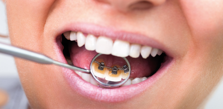 Die Lingualbehandlung und ihre Abrechnung – richterlich erklärt