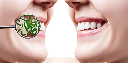 Kann ein Kaugummi krebsassoziierte Keime im Mund reduzieren?