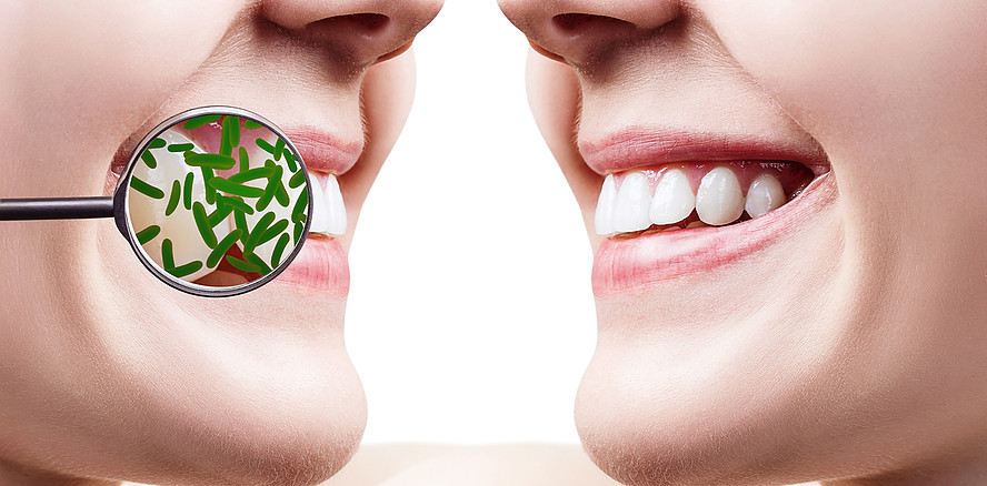 Kann ein Kaugummi krebsassoziierte Keime im Mund gezielt reduzieren?