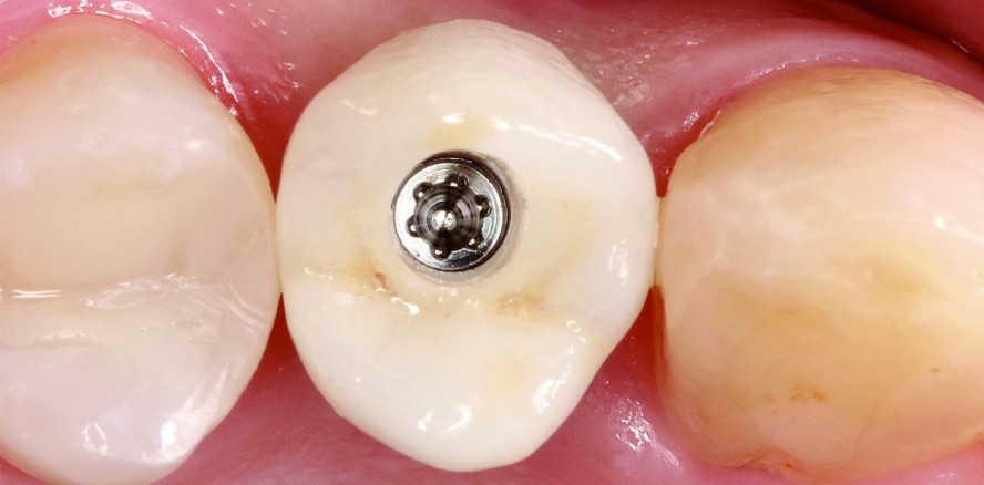 Keramikimplantate – natürlich schön und klinisch bewährt