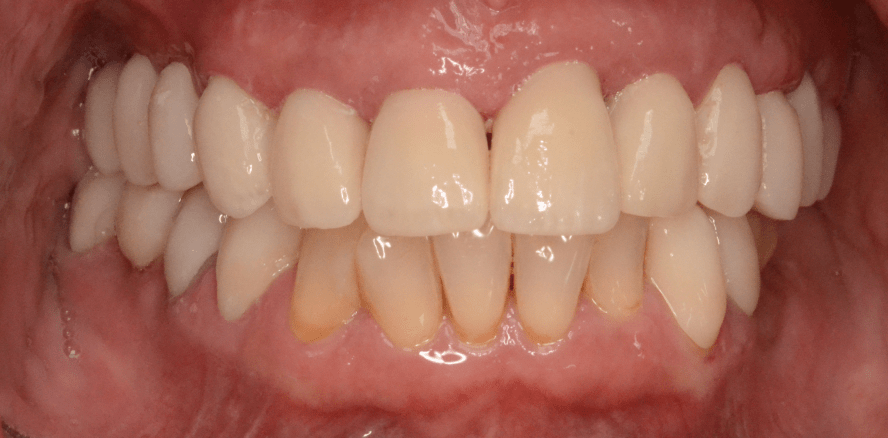 Keramikimplantate bei komplexen prothetischen Restaurationen