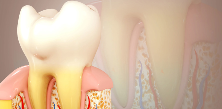 Studie zu Medikamenten bei parodontalem Knochenschwund