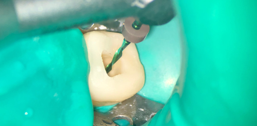 Reziprok & rotierend: Neue Rotationskombination in der Endodontie