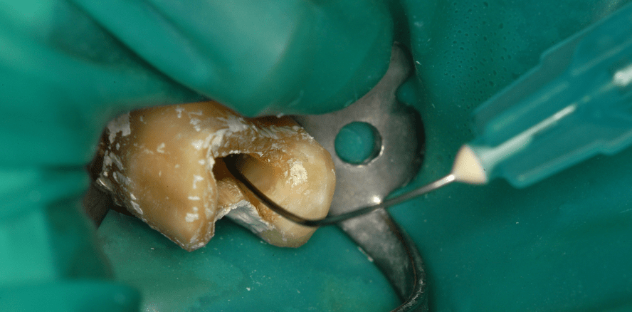Neue Empfehlung Endodontie und Herzgesundheit veröffentlicht