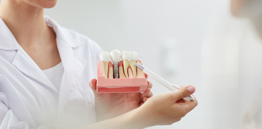 Studie: Komplikationen nach einer Implantattherapie sind häufig