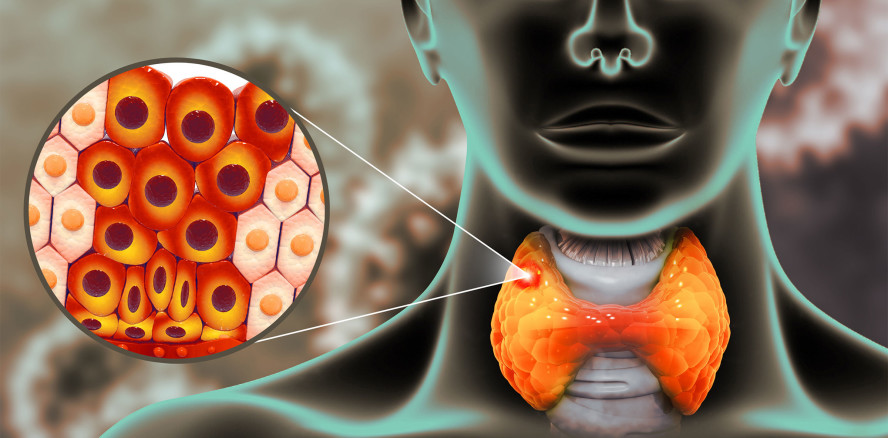 Kopf-Hals-Tumore: Mundgesundheit beeinflusst Überlebensrate