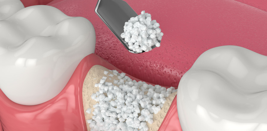 Build Better Bone – Intensivkurs zur augmentativen Chirurgie mit Live-OP