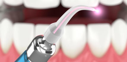 Laserlicht löst Kronen, Veneers und Brackets
