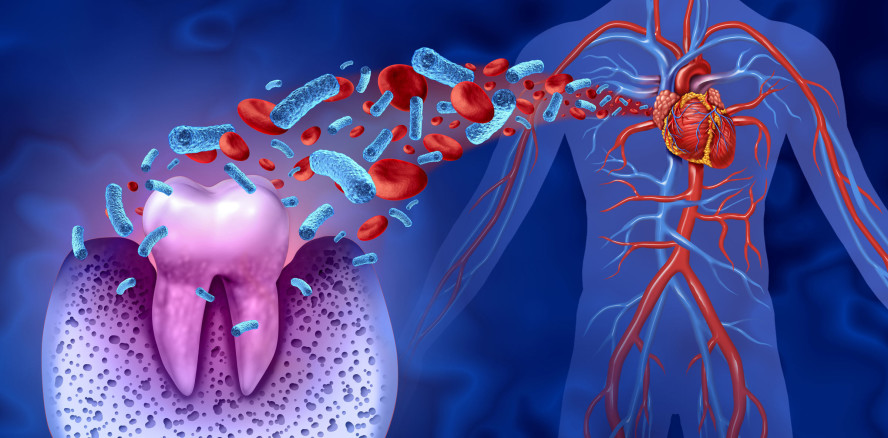 Leitlinie zur Behandlung von fortgeschrittener Parodontitis