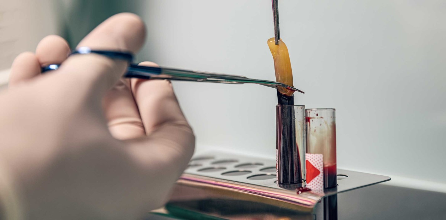 Weltweit erste Leitlinie: Platelet-Rich-Fibrin in der Implantologie