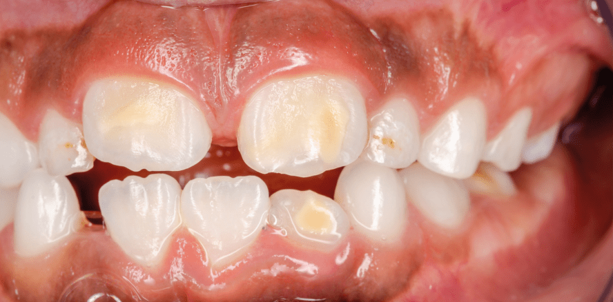 Patientenberatung: Was tun bei Molaren-Inzisiven-Hypomineralisation?