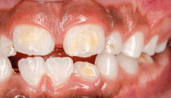 Patientenberatung: Was tun bei Molaren-Inzisiven-Hypomineralisation?