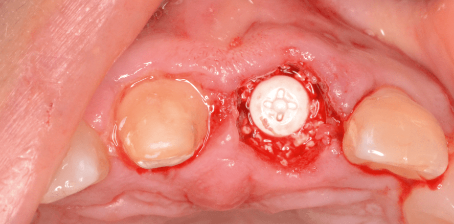 Möglichkeiten von zweiteiligen Keramikimplantaten