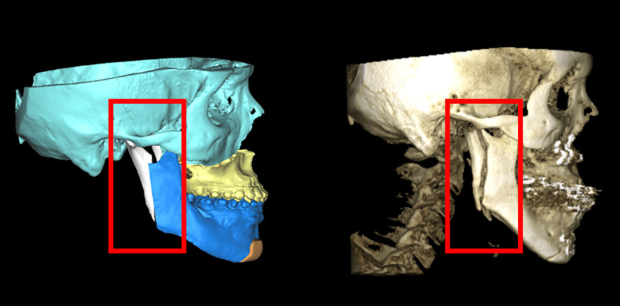 Mandibuläre Prognathie: Fixierung verbessert Lebensqualität