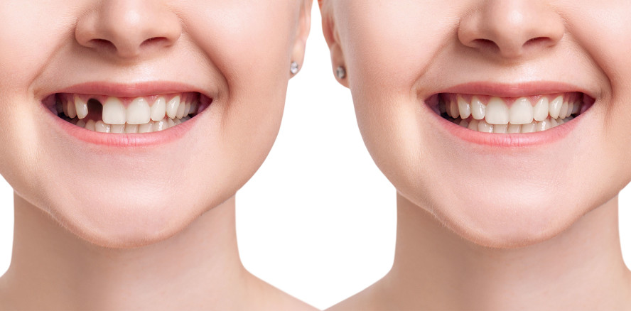 Neues Medikament soll Zähne nachwachsen lassen