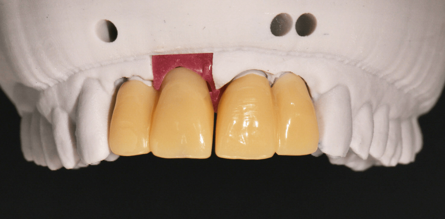 Monolithische Zirkonoxidkronen in der ästhetischen Zone