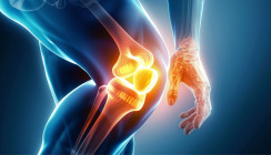 Orale Bakterien verschärfen die Entzündung bei Arthritis